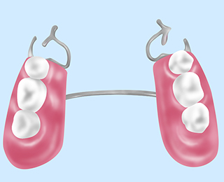 部分入れ歯（部分床義歯）