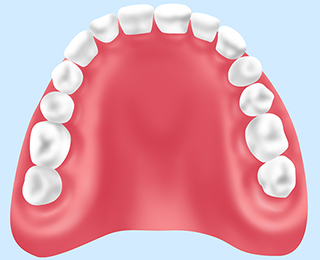 レジン床義歯（保険診療）