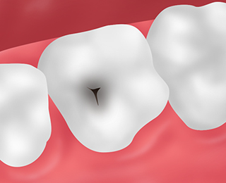 虫歯とは？