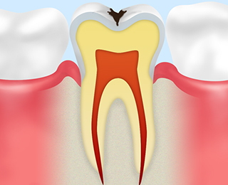 C1：【エナメル質の虫歯】