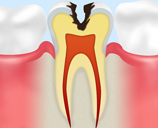 C2：【象牙質の虫歯】
