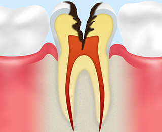 C3：【神経まで達した虫歯】