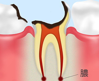 C4：【歯根まで達した虫歯】