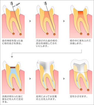 根管治療について