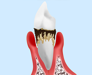 歯周病の原因とは？
