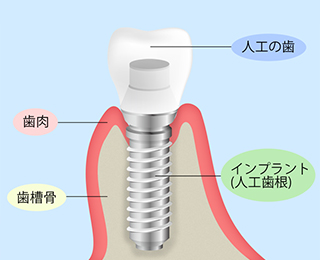 インプラントってどういう治療？