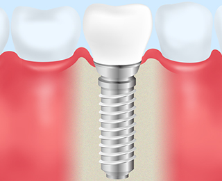 インプラント