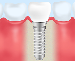 インプラント