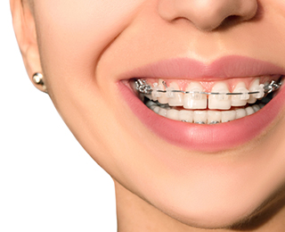 歯並び改善で身体の健康もアップ“矯正歯科”